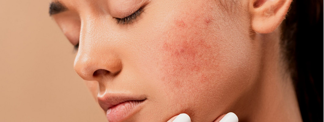 Những nơi nổi mụn sẽ xác nhận tình hình sức khỏe bản thân ! Những nơi nổi mụn sẽ xác nhận tình hình sức khỏe bản thân !