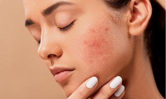 Những nơi nổi mụn sẽ xác nhận tình hình sức khỏe bản thân !
